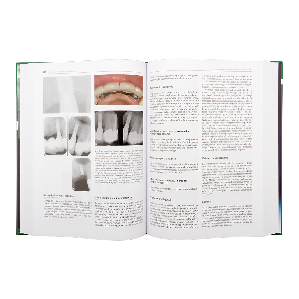 Книга: Осложнения в имплантологии (Стюарт Фроум)